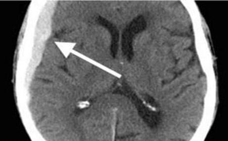 如何科学护理脑血栓患者